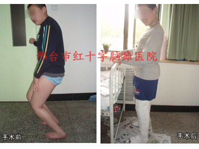 微創(chuàng)矯形手術(shù)治療小兒腦癱哪里效果好？邢臺(tái)腦癱醫(yī)院